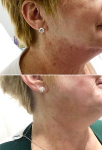 Before and After Lumecca Treatment MedSpa 370